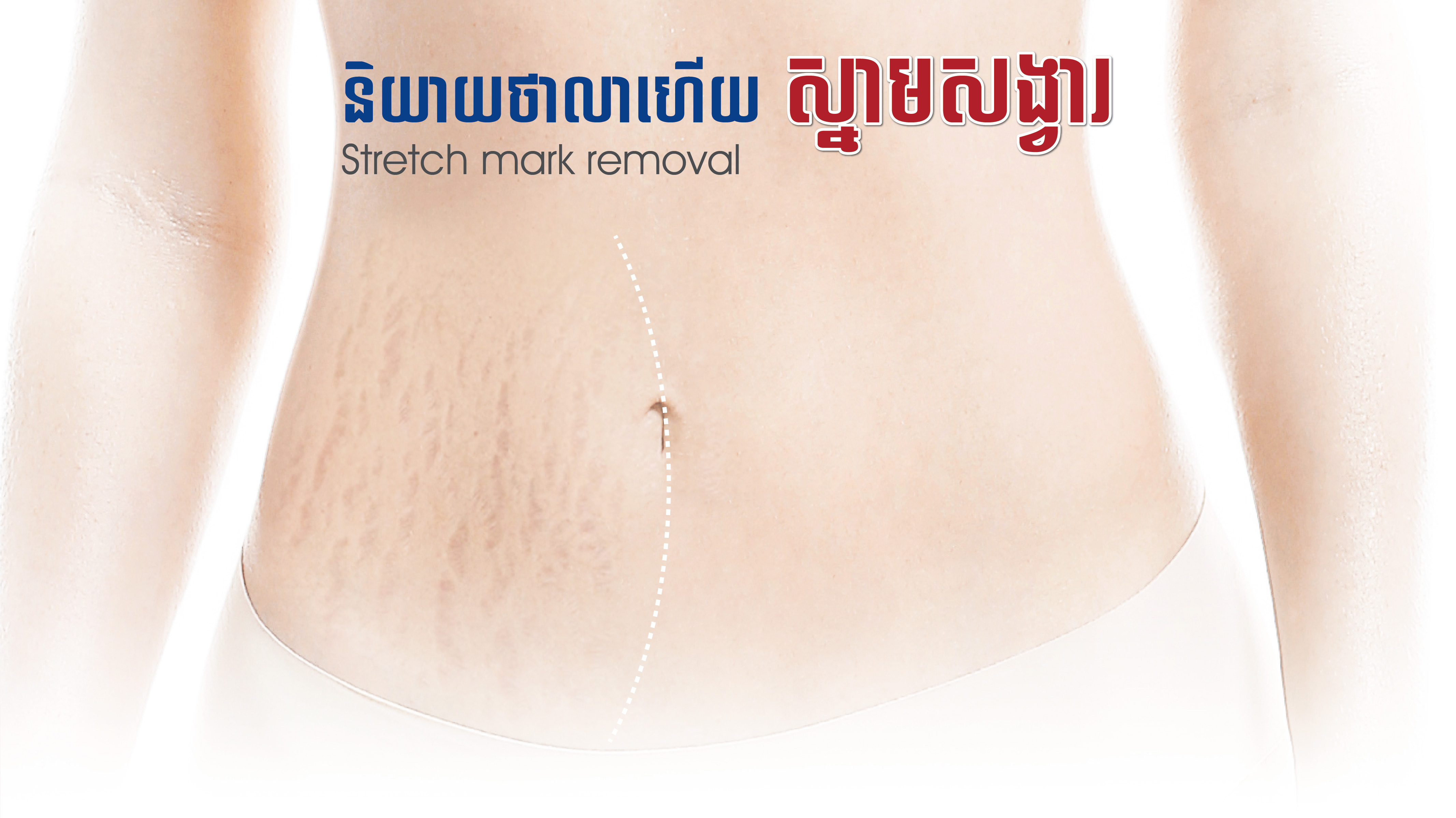 Stretch mark removal